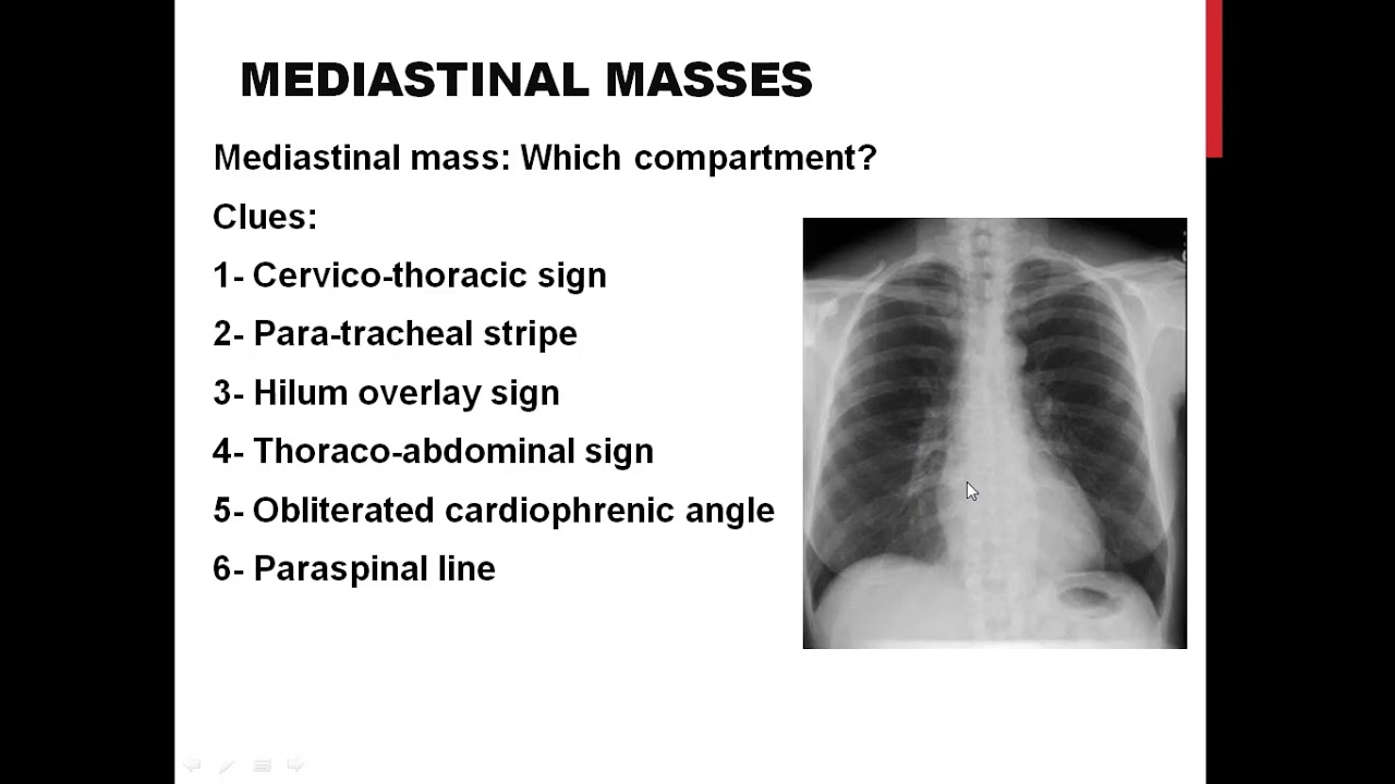 Mediastinal Masses Dr Hesham El Sheikh