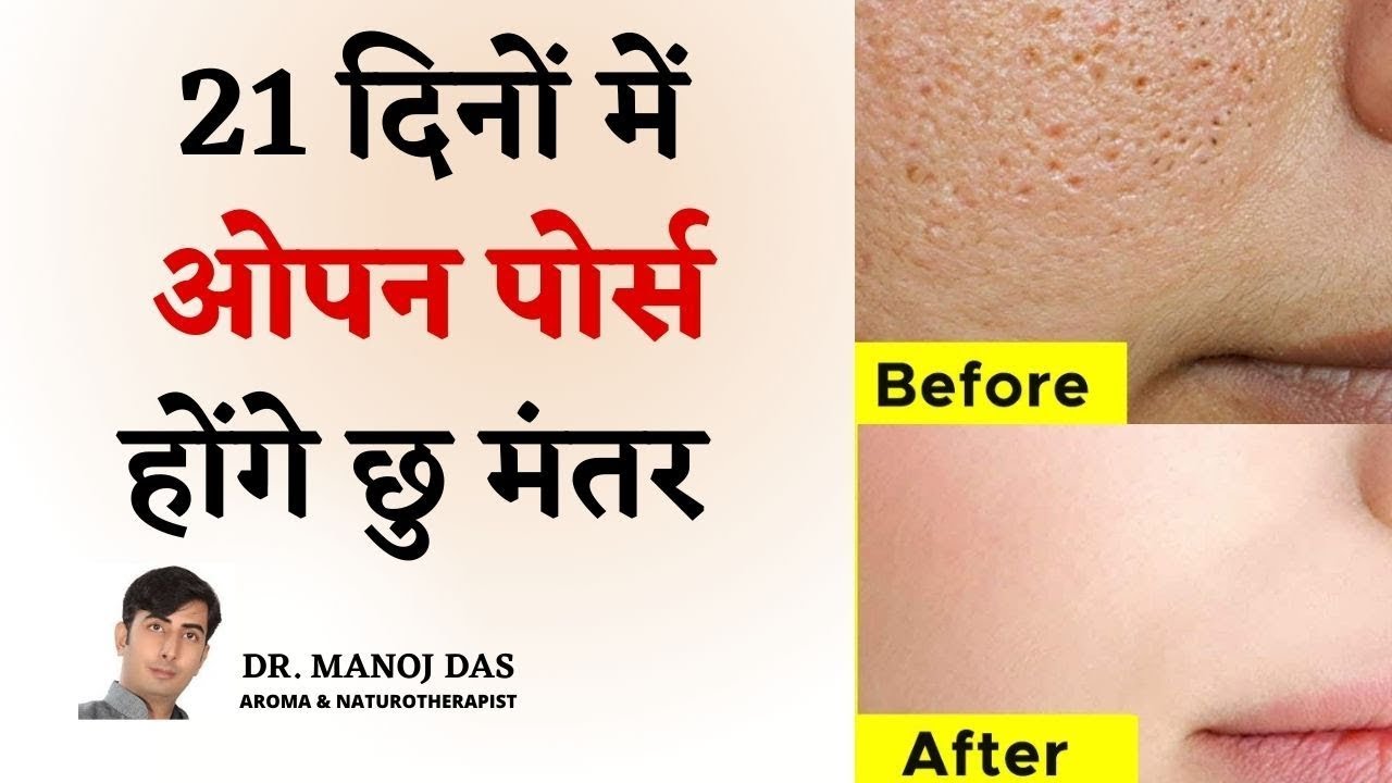 21 दिनों में खत्म Clogged Pores, Blackheads, Bumps, Whiteheads and Large Pores I DR. MANOJ DAS