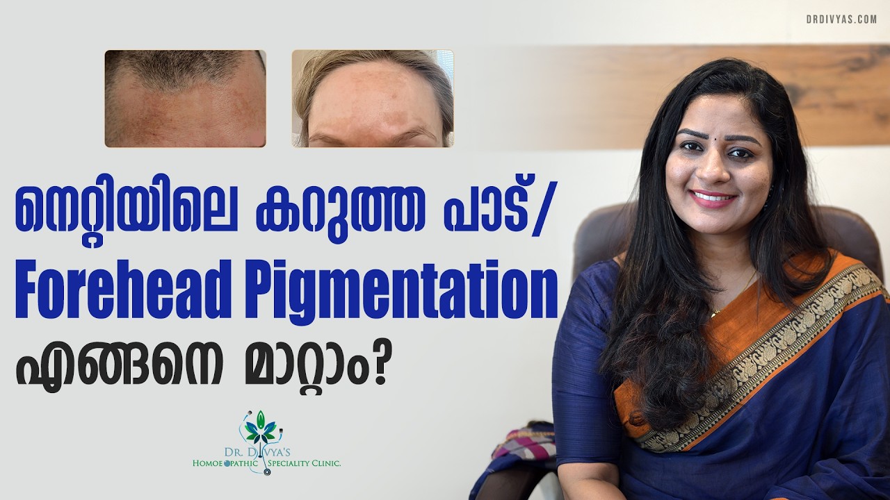 നെറ്റിയിലെ കറുത്ത പാട് എങ്ങനെ മാറ്റാം How to Get Rid of Forehead Hyperpigmentation (Dark Spots)