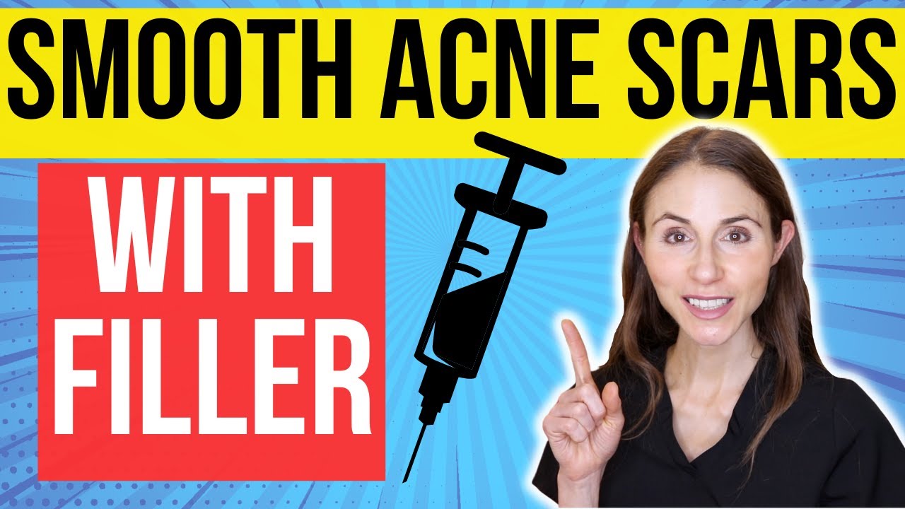Filler For Acne Scars | Dermatologist Explains