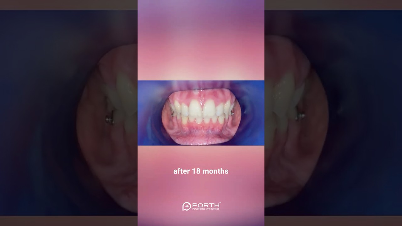 See how 18 months of orthodontic treatment transformed this smile! 😃
