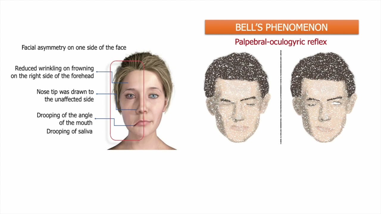 Bell's Palsy