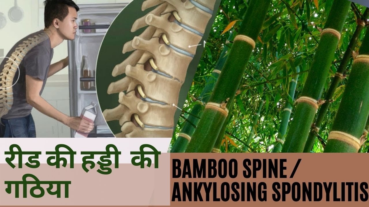 Ankylosing spondylitis /Bamboo spine | रीढ़ की हड्डी की गठिया क्या होती है |कैसे होती है