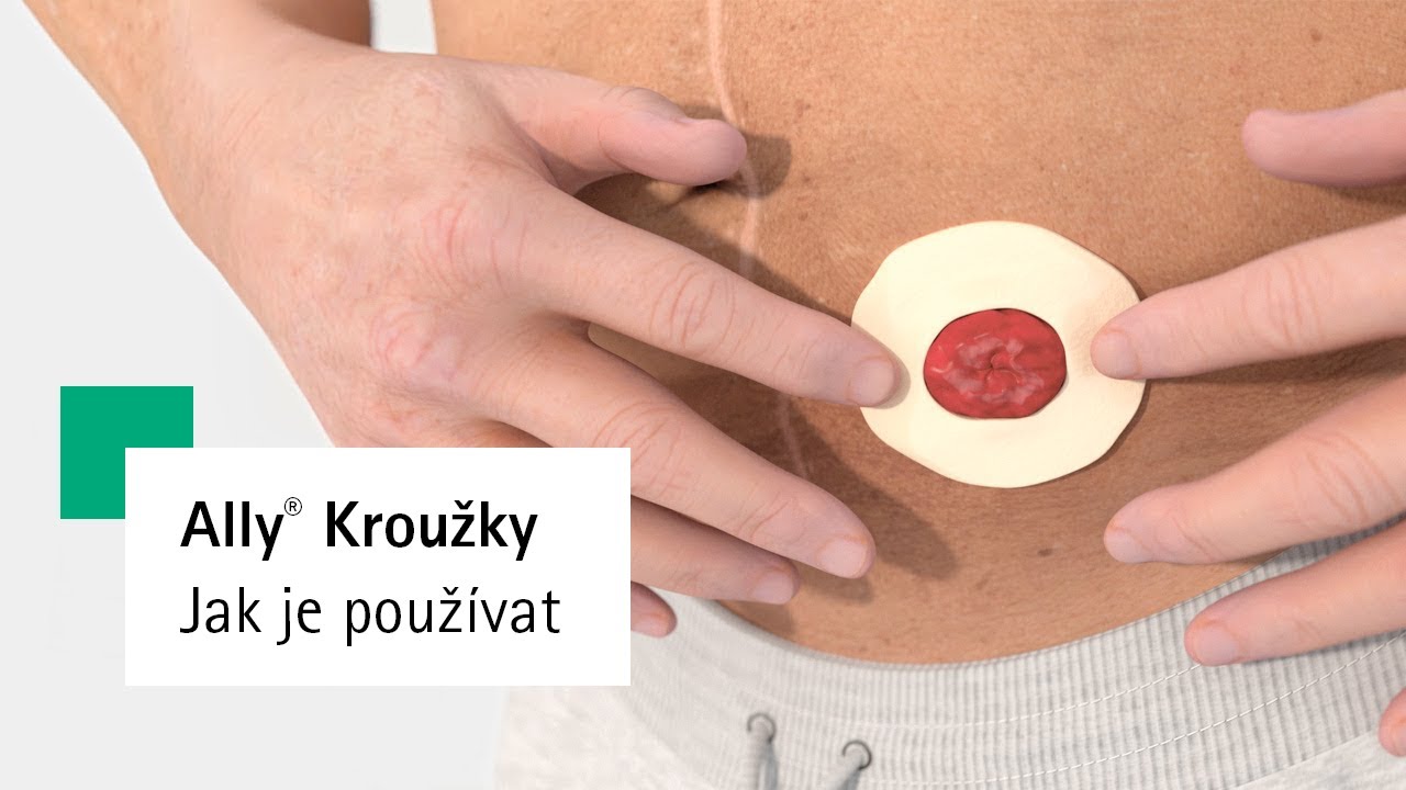 Ally® Stomické těsnicí kroužky | Jak na to
