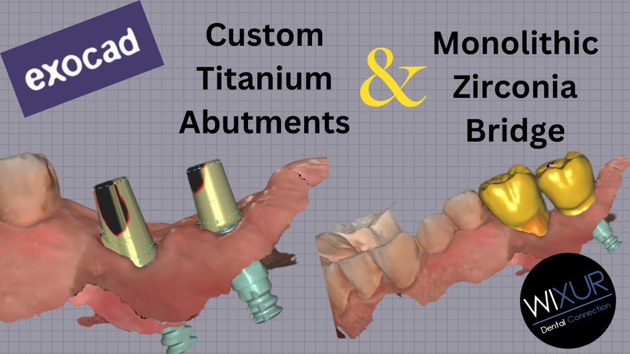 Custom Titanium Abutments & Monolithic Zirconia Bridge