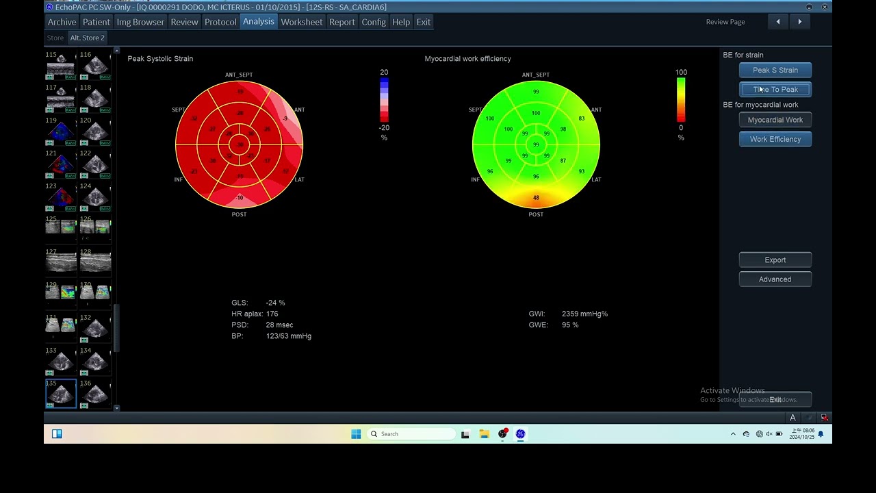 IQ 291 GWE MYOCARDIAL WORK INDEX EFFICIENCY  ECHOPAC ANALYSIS ECHOCARDIOGRAPHY