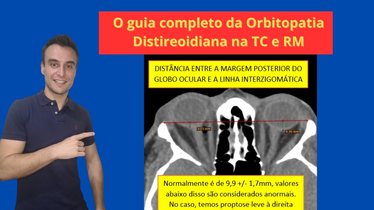 Como medir exoftalmia na orbitopatia de graves pela tomografia e ressonância