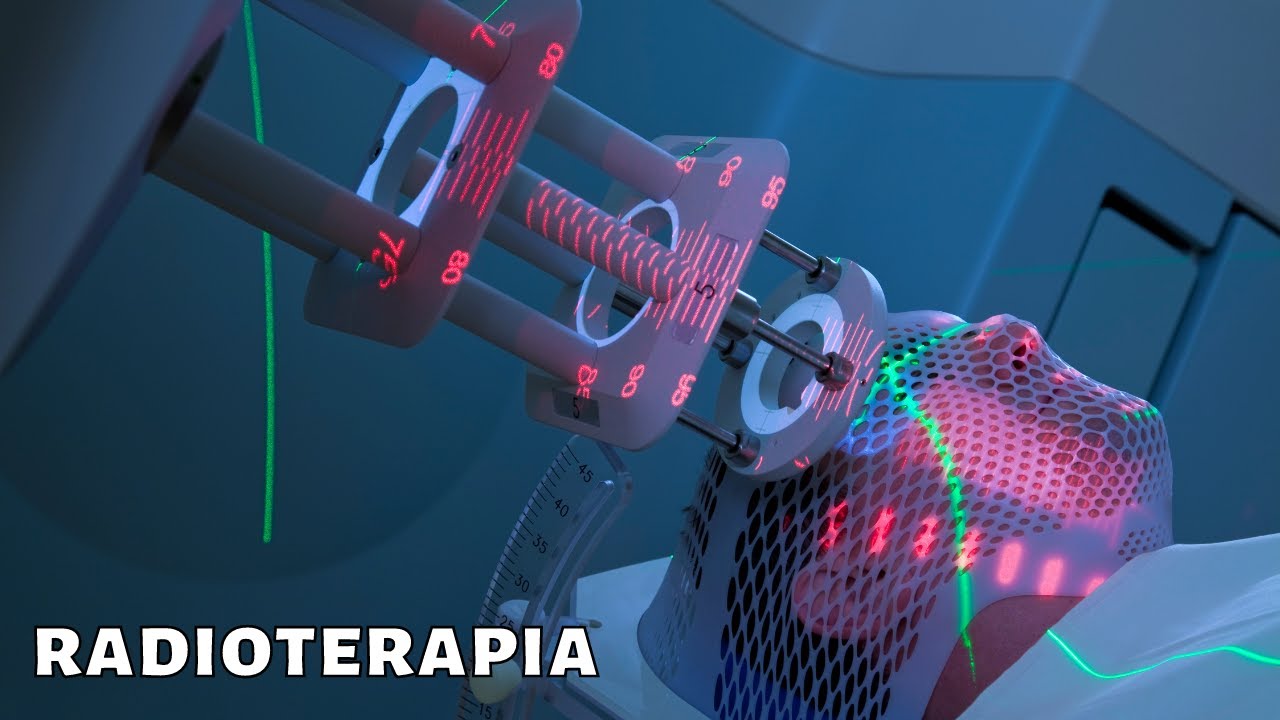 La RADIOTERAPIA explicada: cómo funciona, tipos y efectos⚕️