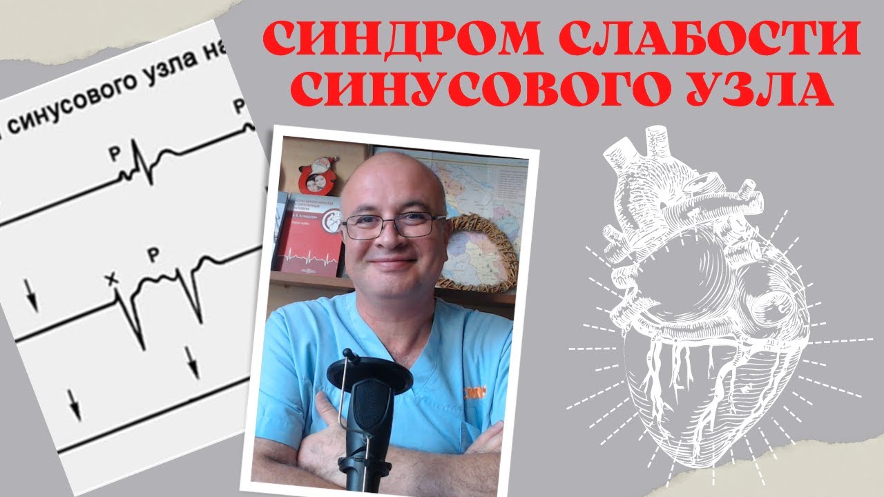 Синдром слабости синусового узла (СССУ). Дисфункция синусового узла