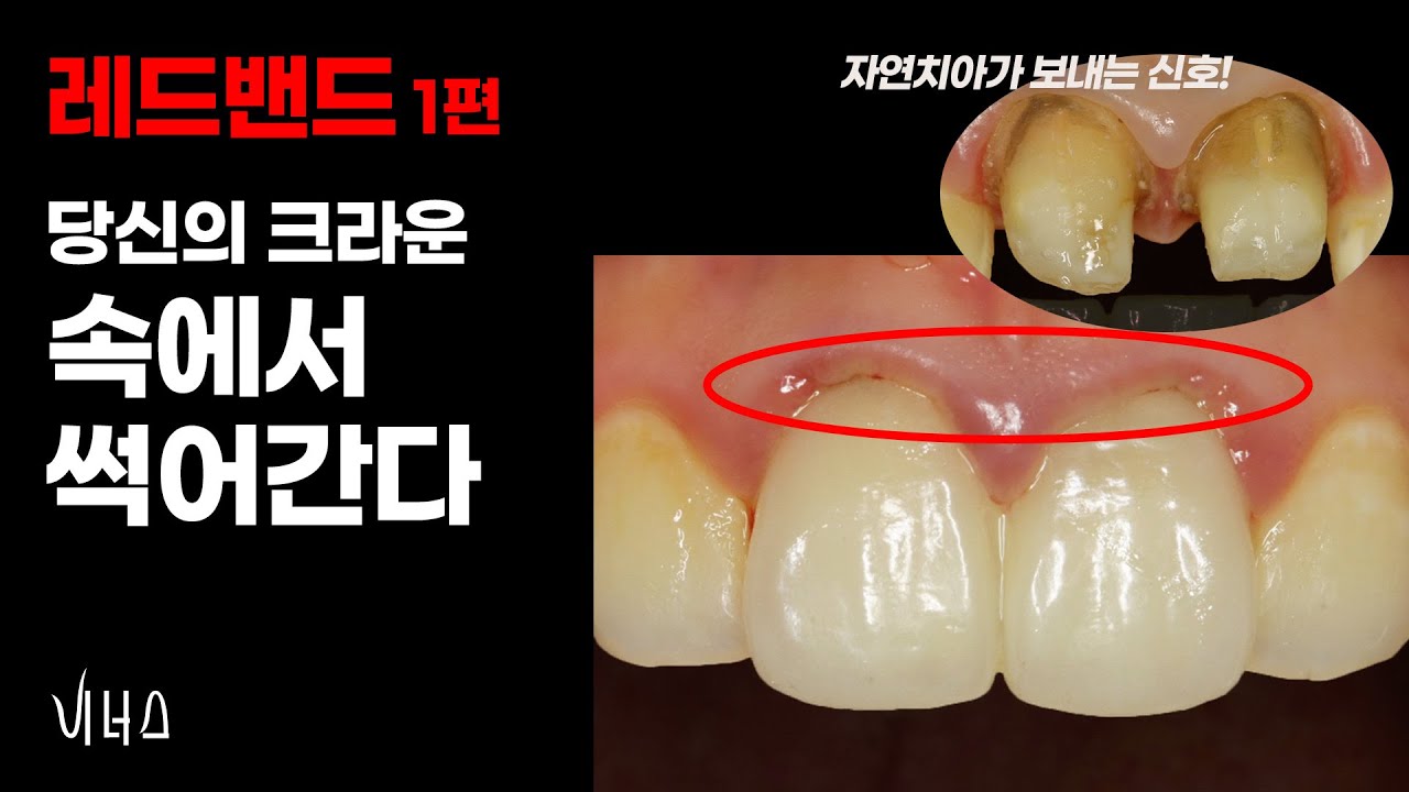 크라운 속이 썩었는지 확인하는 유일한 방법  I  앞니 치과 비너스 원장의 앞니 치료 이야기
