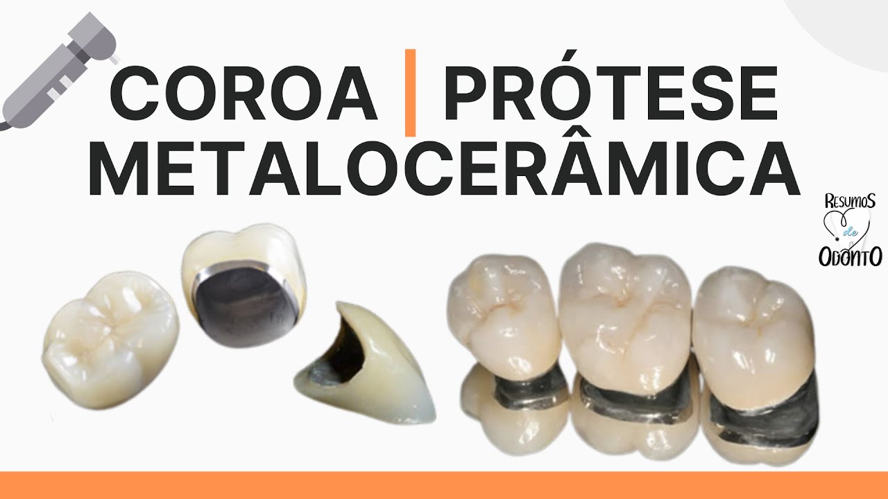 COROA METALOCERÂMICA | Resumos de Odonto