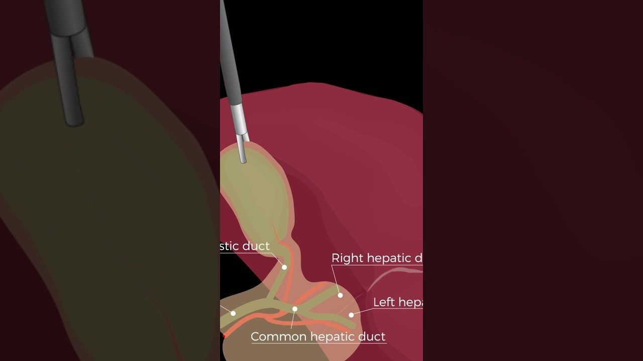 Lap Chole: the first major laparoscopic procedure a resident performs from start to finish