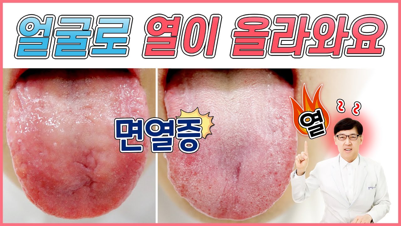 면열증: 얼굴로 열이 올라와요