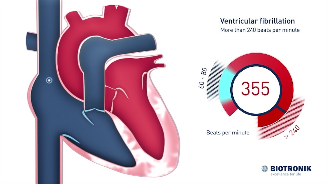 Fibrilaci&oacute;n ventricular y muerte s&uacute;bita cardiaca