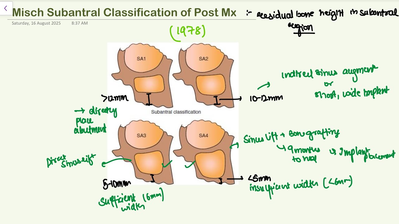 Misch Subantral Classification of Posterior Maxilla Prosthodontics 