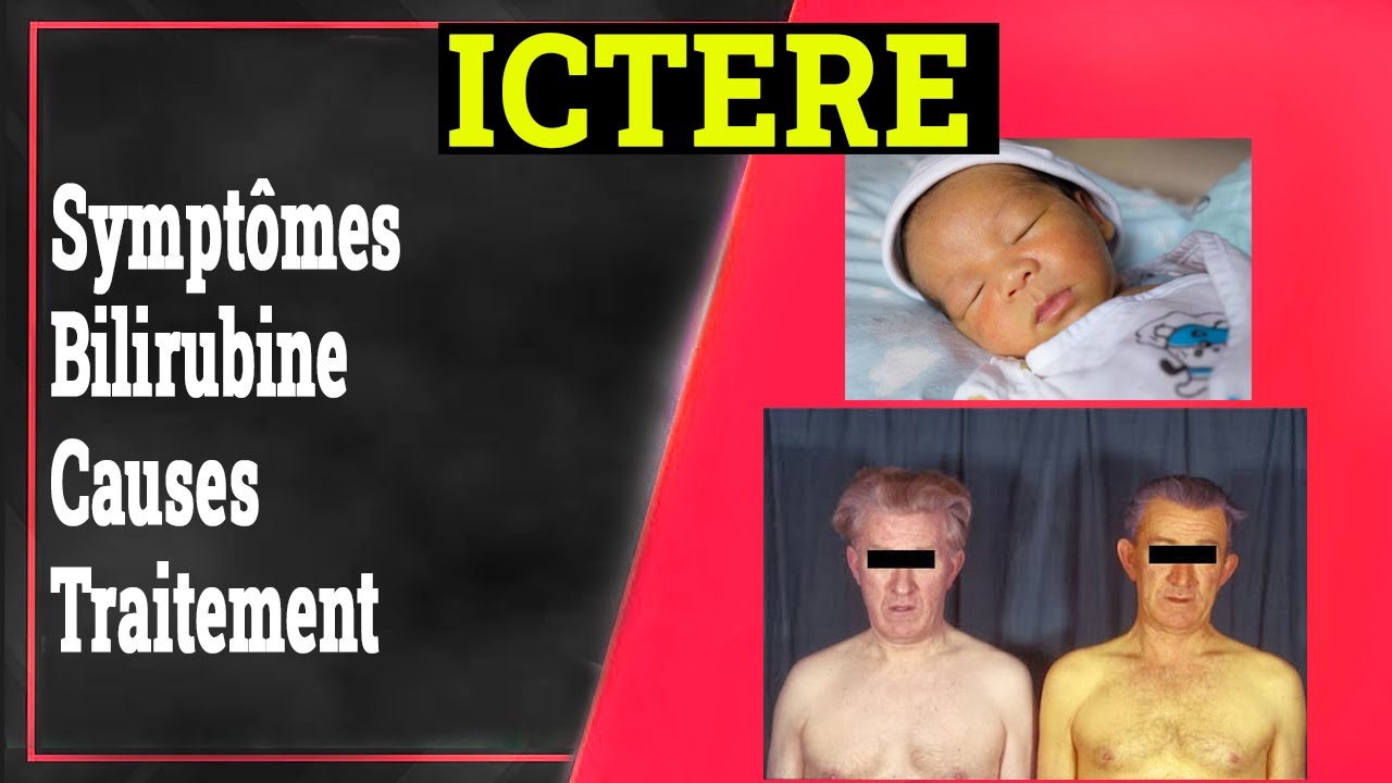 Ictère: Conduite a Tenir, Causes, Traitement | Gastrologie Medicale