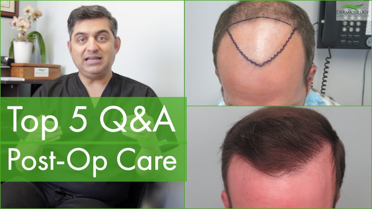 Hair Transplant TOP 5 QUESTIONS - Post-Op Care