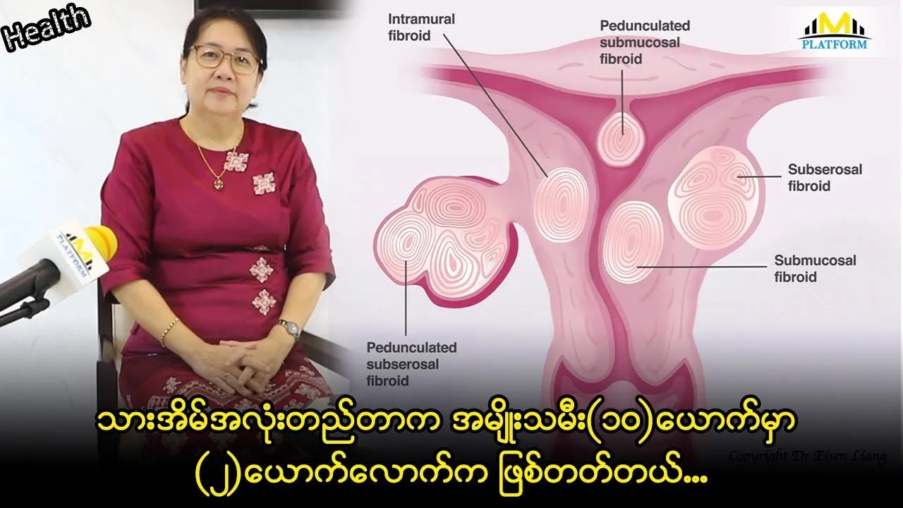 သားအိမ်အသားလုံးတည်တာက ကလေးမွေးတဲ့အရွယ်အမျိုးသမီးတွေမှာ အများဆုံးဖြစ်တတ်တယ်။