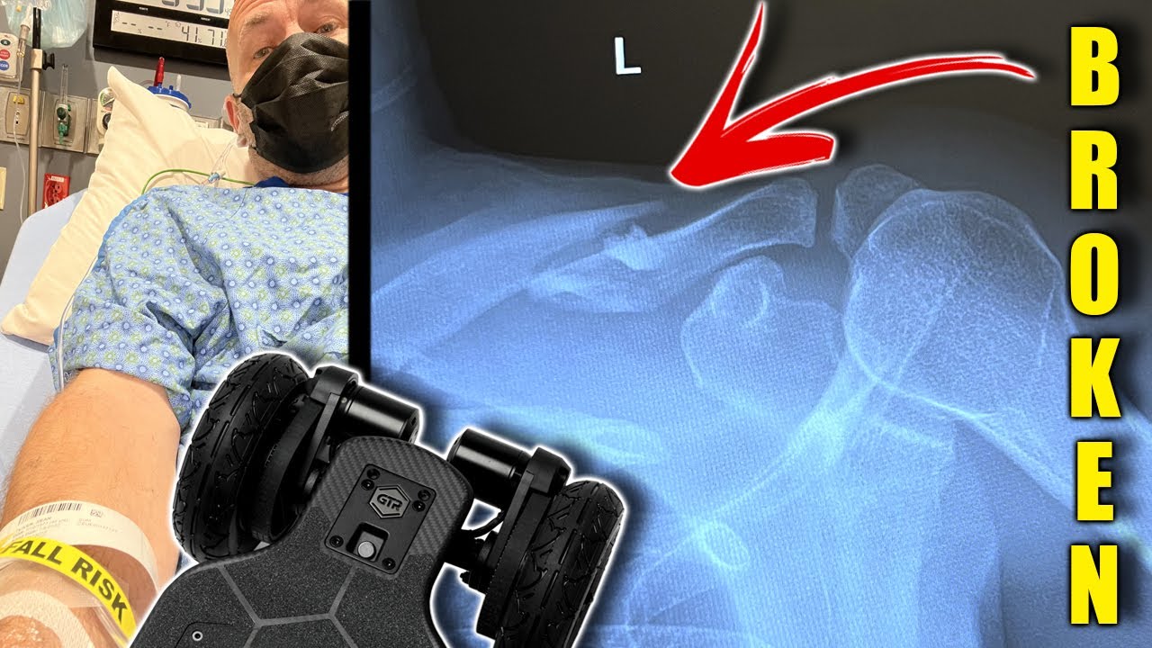 I Broke My Collarbone - Evolve Electric Skateboard GTR Brake Issue Discussed