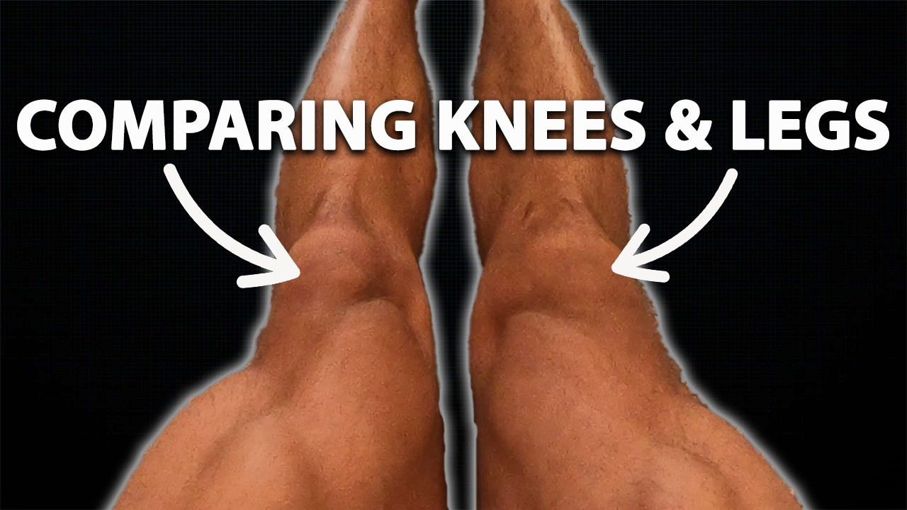 Comparing Knees & Legs 1 Year Post ACL Surgery