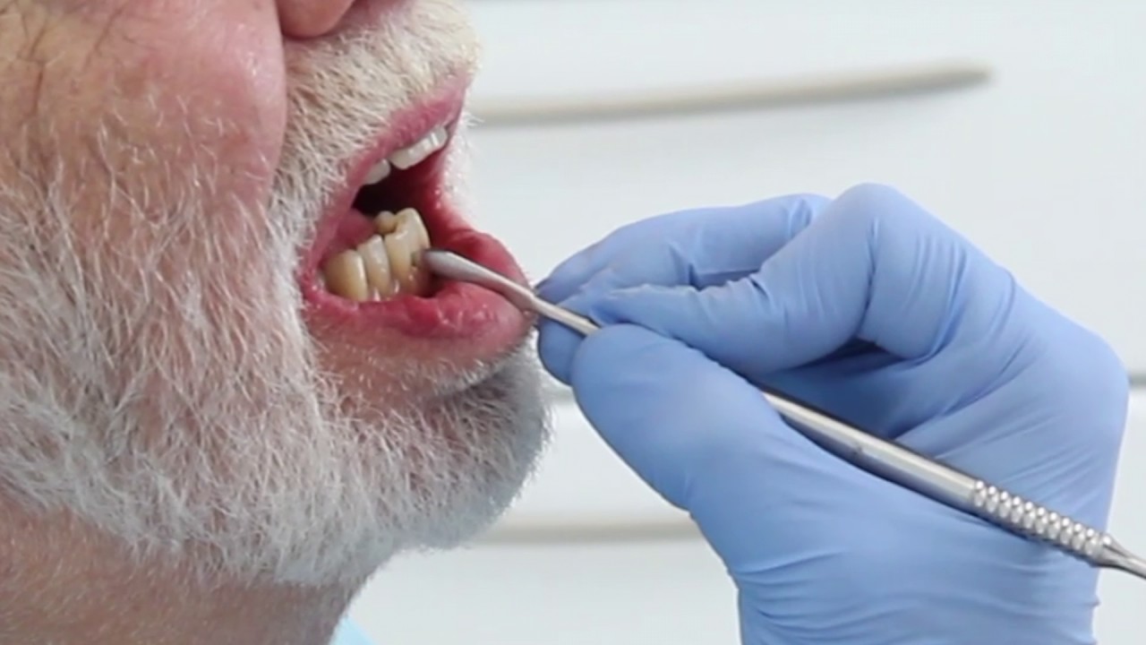 Superb retention and stability of complete lower denture without implants.