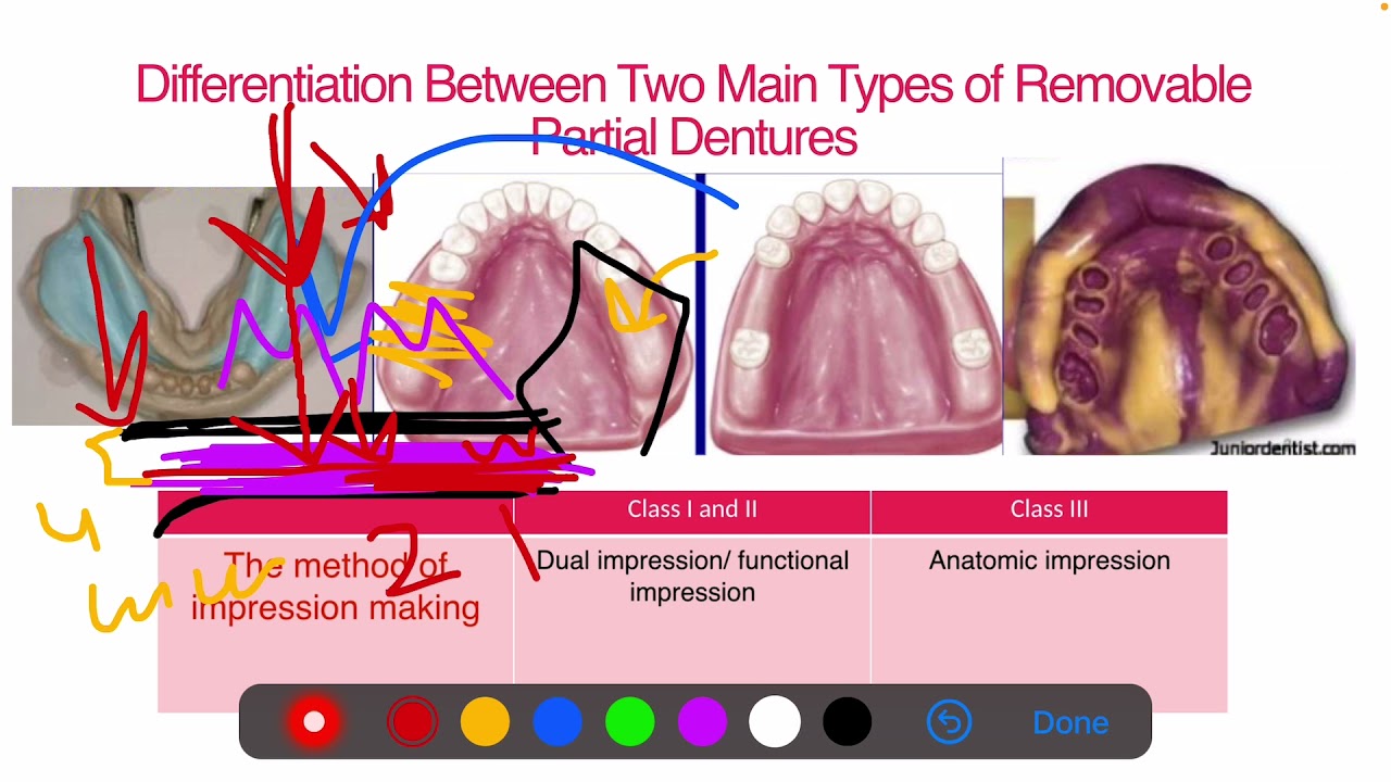 3-16/17 Prosthodontics, Designing of Partial Denture.