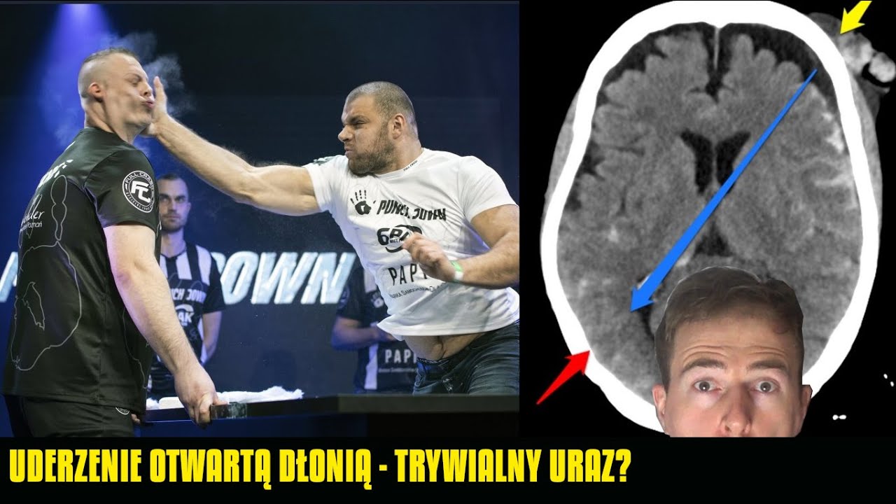 DLACZEGO UMARŁ ARTUR WALCZAK. Cios otwartą dłonią - LEKARZ TŁUMACZY