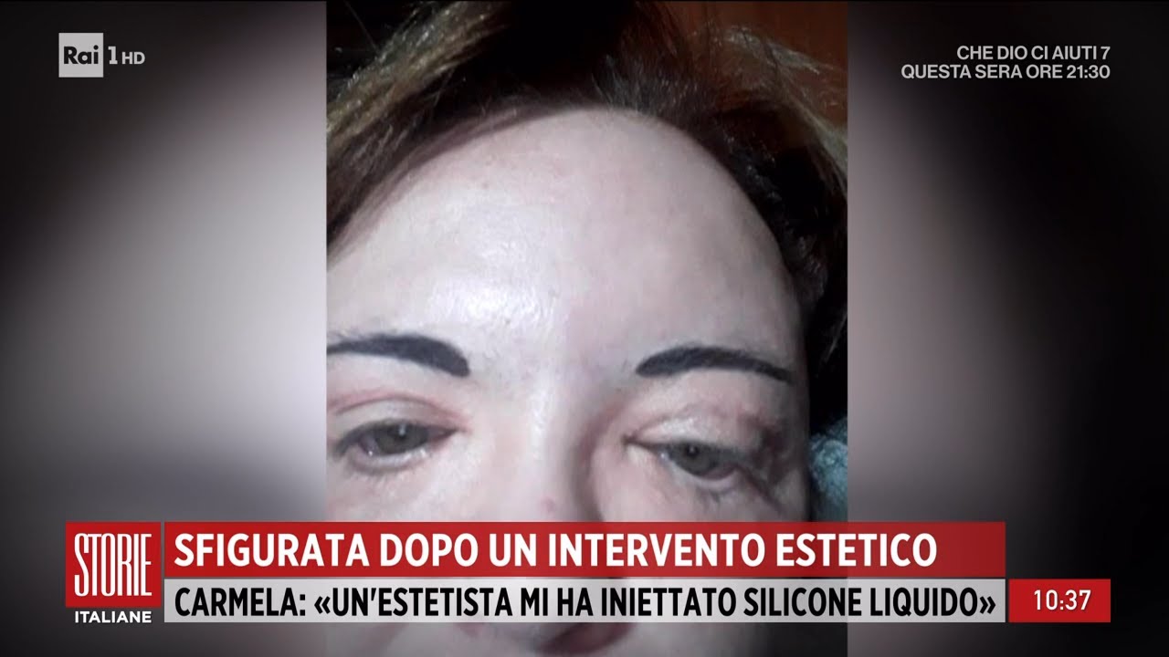 Sfigurata dopo un intervento estetico - Storie Italiane 09/03/2023