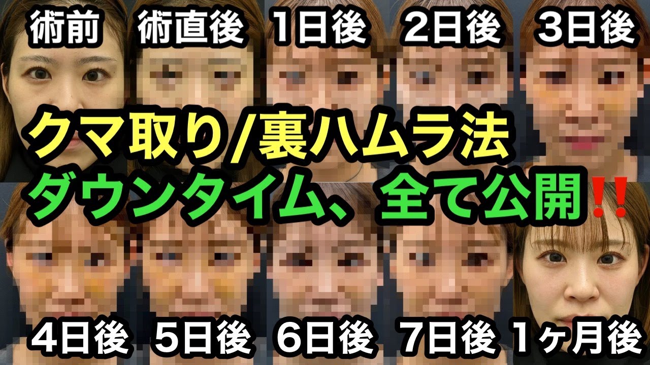 【クマ取り/裏ハムラ法】ダウンタイム術後１週間毎日見せます！part2