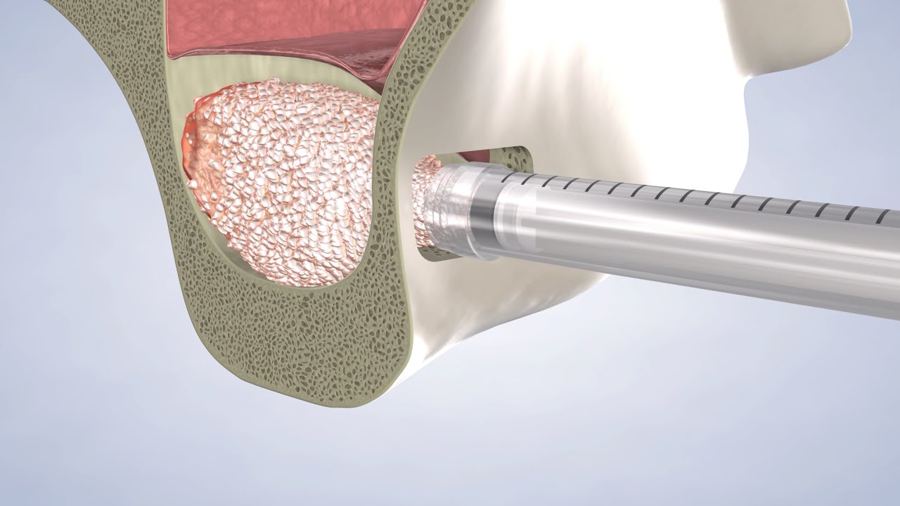 Sinus Preservation at Oral Surgery & Dental Implant Specialists of Cincinnati