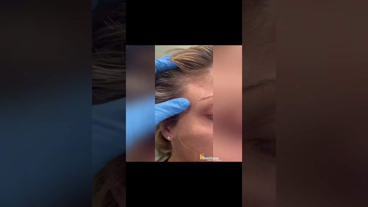 V Boutique - Masseter and temporalis muscle hypertrophy treatment