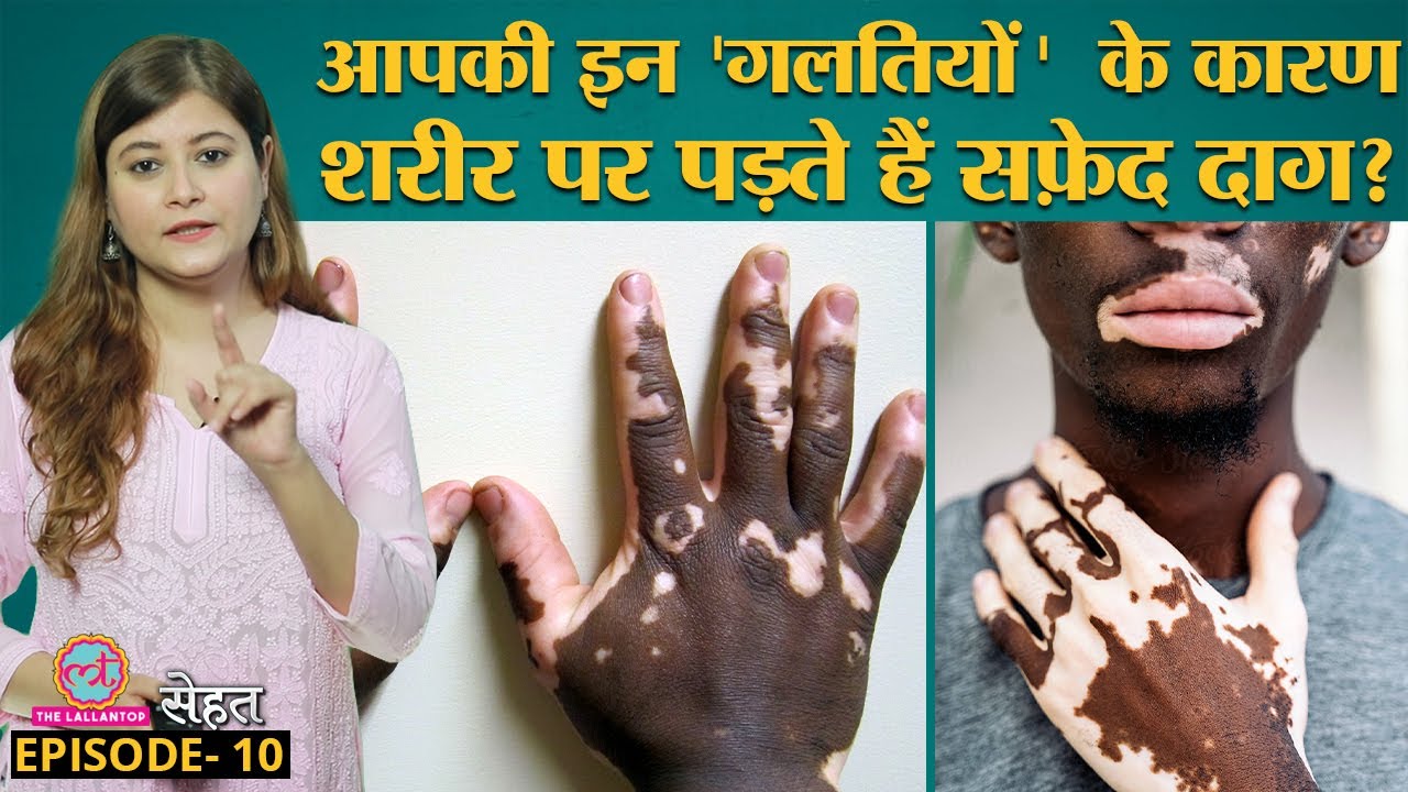 शरीर पर सफ़ेद दाग पड़ने वाली बीमारी Vitiligo क्या ठीक हो सकती है? Sehat Ep 10