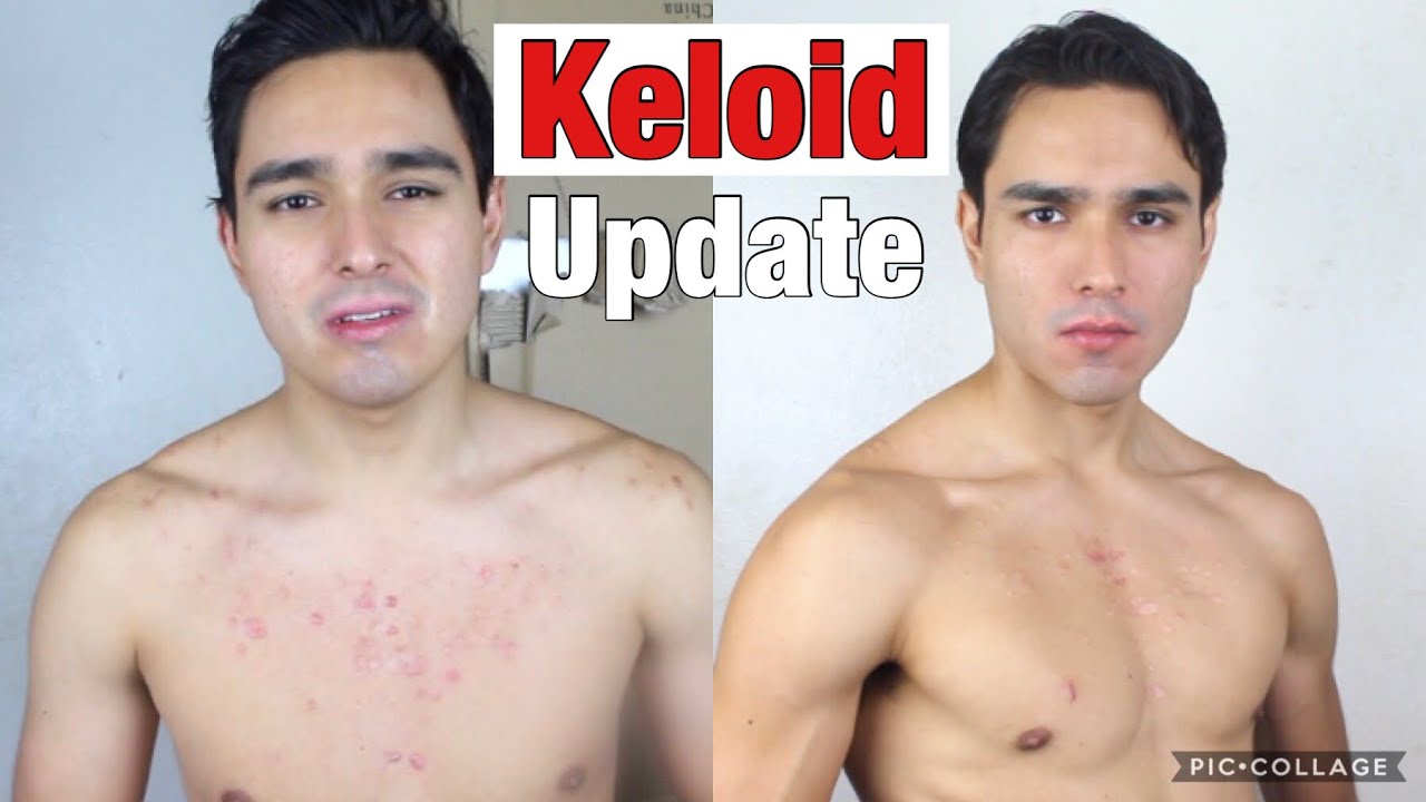 3 Year Keloid Update (What I'm Doing Right Now, Plans for The Future, & More).