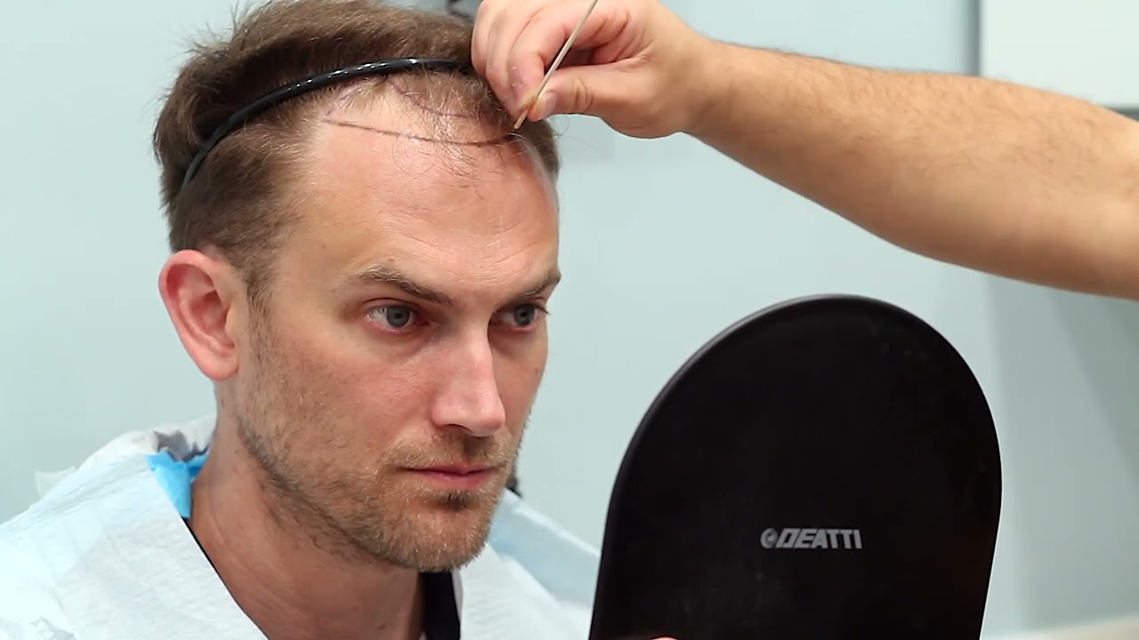 FUE Hair Transplant (Dr. Sean Behnam)