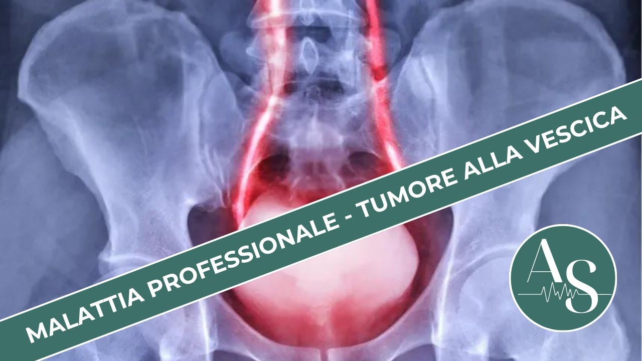 Malattia professionale cancro vescicale