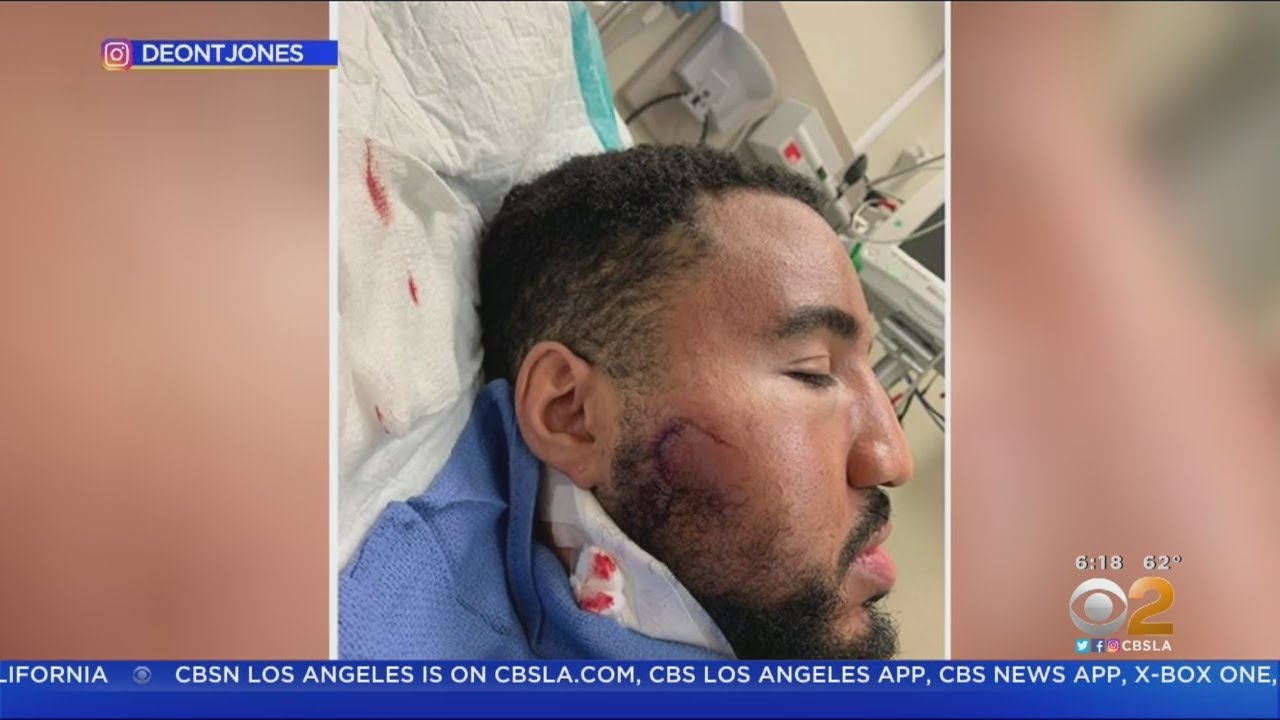 Protester Deon Jones Describes Being Shot With Rubber Bullet By Police