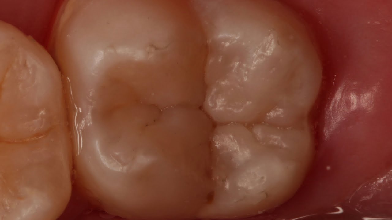 Dente 37 ANATOMIA 