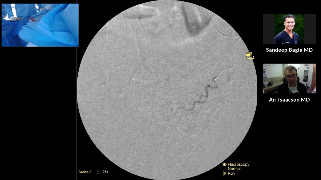 PAE: Live Radial Prostatic Artery Embolization with Dr. Bagla