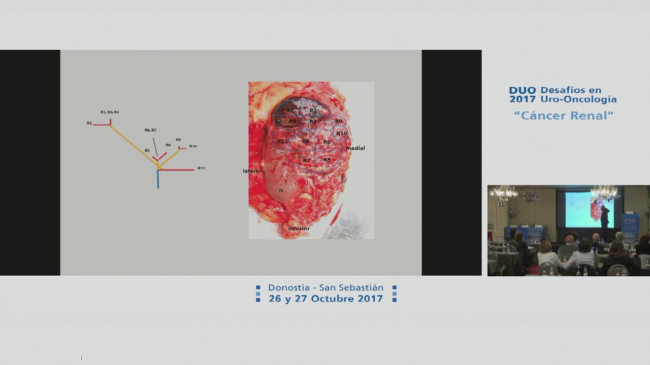 Dr. Guido Martignoni, Dr. José Ignacio López “¿Carcinomas renales CON células claras?“