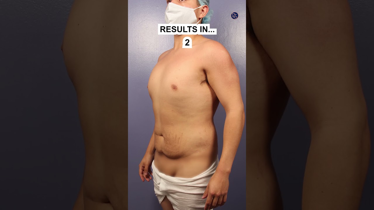 INSANE Weightloss to Tummy Tuck Transformation