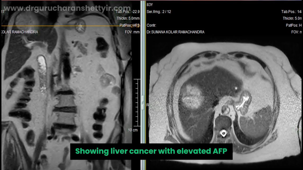 TACE-Transarterial Chemoembolisation for Hepatocellular Carcinoma(HCC)