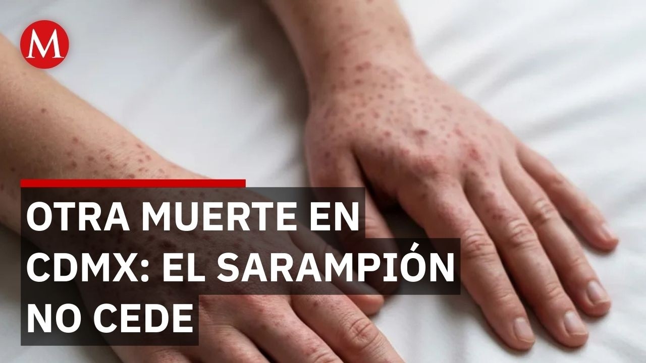 CDMX reporta otra muerte por sarampión: México ya supera los 13 mil casos