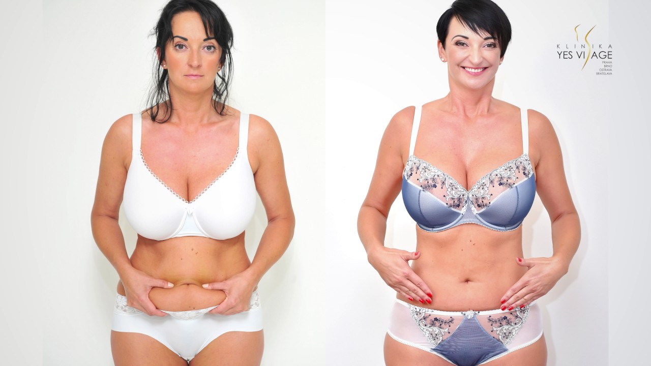 PROMĚNA: Laserová liposukce SlimLipo v oblasti břicha u paní Juliany na Klinice YES VISAGE