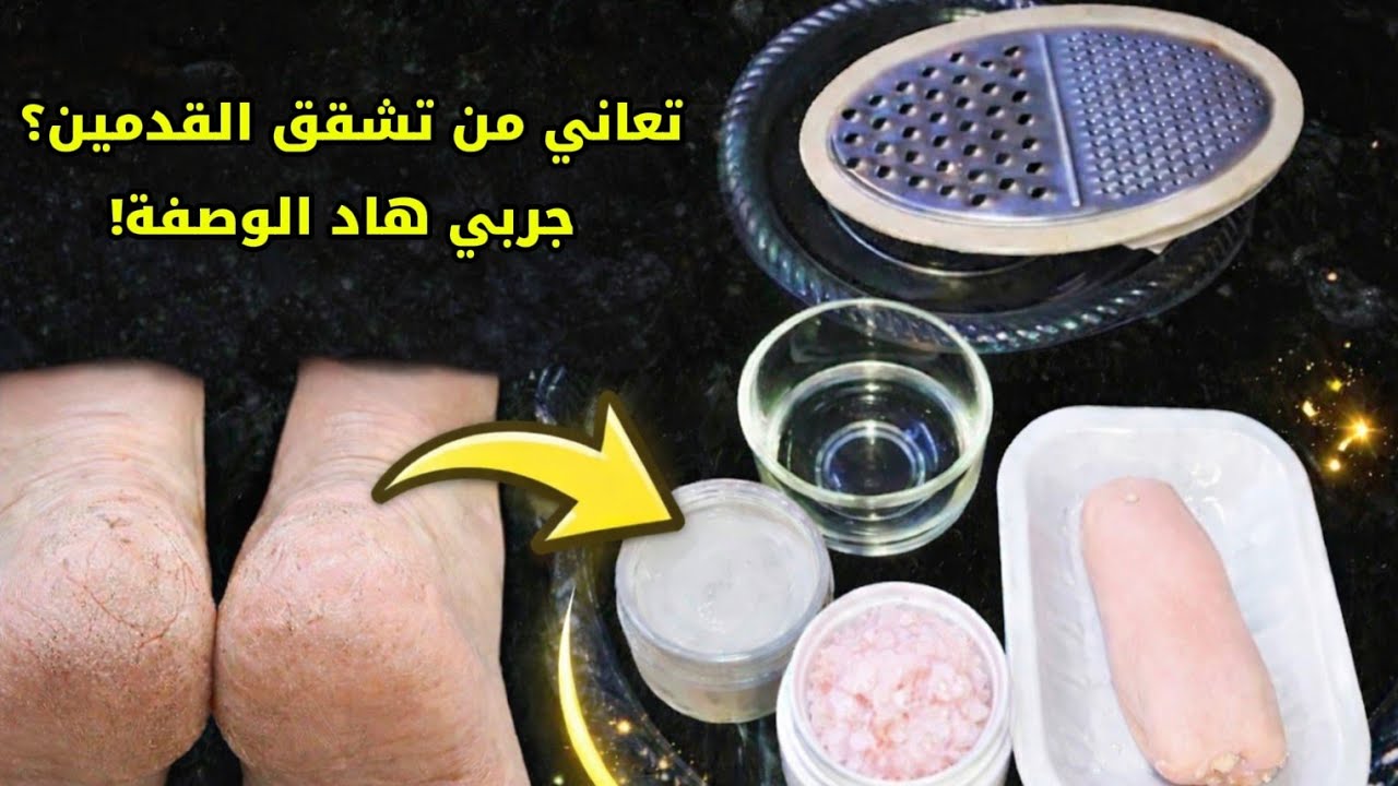 تعاني من تشقق القدمين؟ جربي هاد الوصفة!