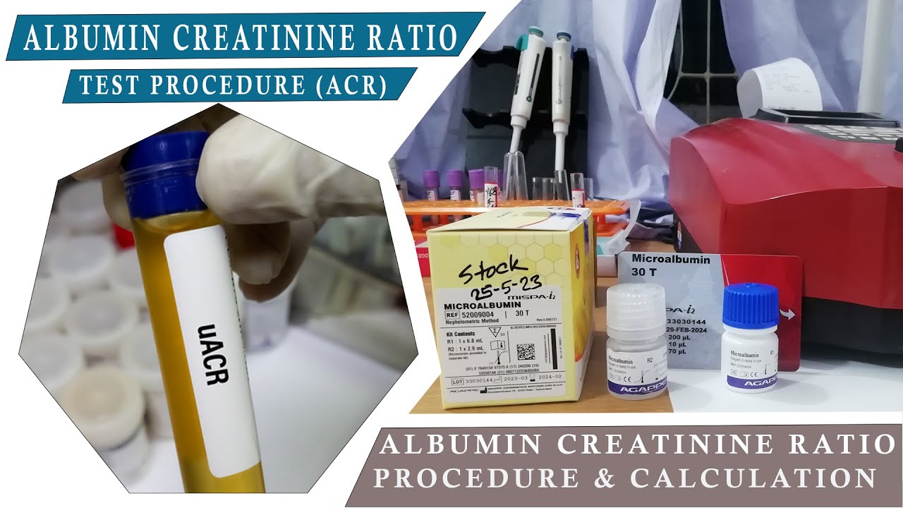 ALBUMIN CREATININE RATION (ACR)/ How to Microalbumin Test & Urine Creatinine Test Procedure.