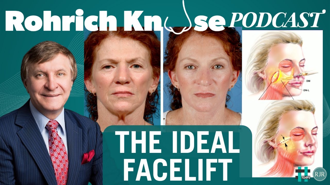 The Ideal Facelift!