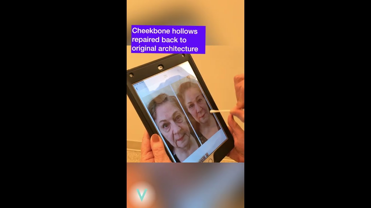 Dr. Stephen Bracci's Patient Reacts To Her Non Surgical Baselift Results: Before & After
