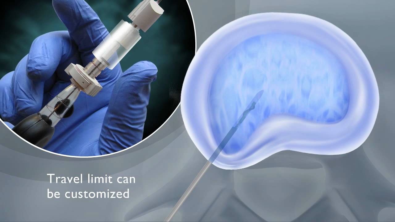 enSpire Interventional Discectomy System