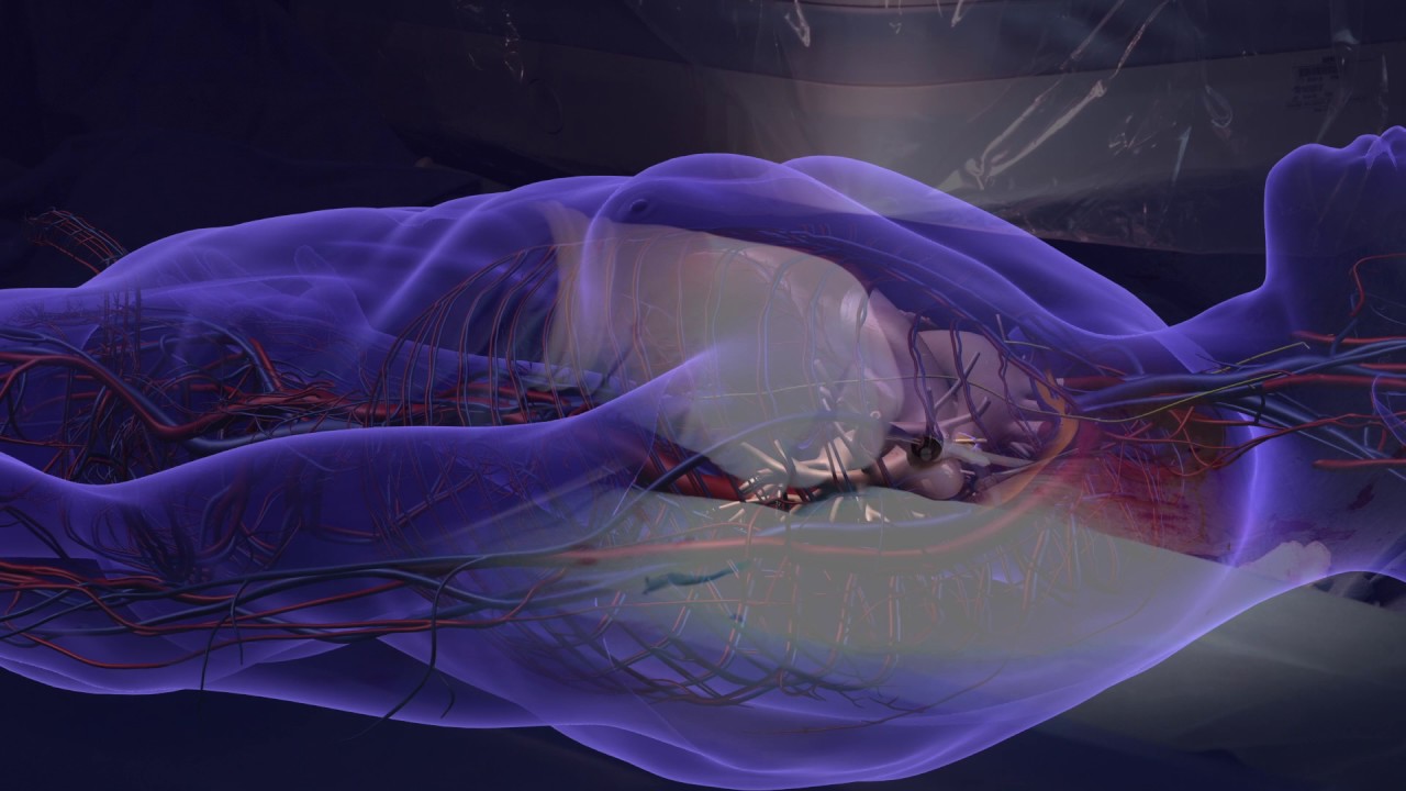 Plaatsing pacemaker onder 3D-beeldgestuurde geleiding