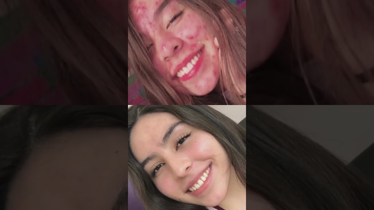 Tratamiento integral para Acné | Antes y Después 